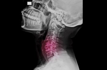 Unveiling Cervical Myelopathy Causes And Treatment Options For Neck