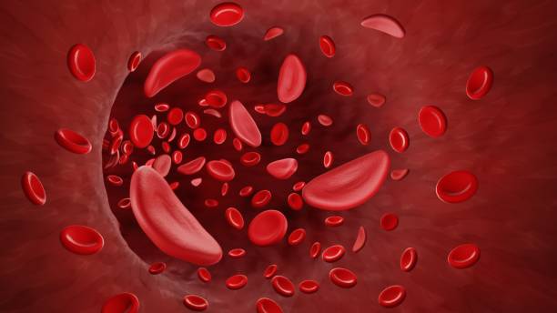 Sickle Cell Anemia Understanding The Symptoms Causes And Prevention